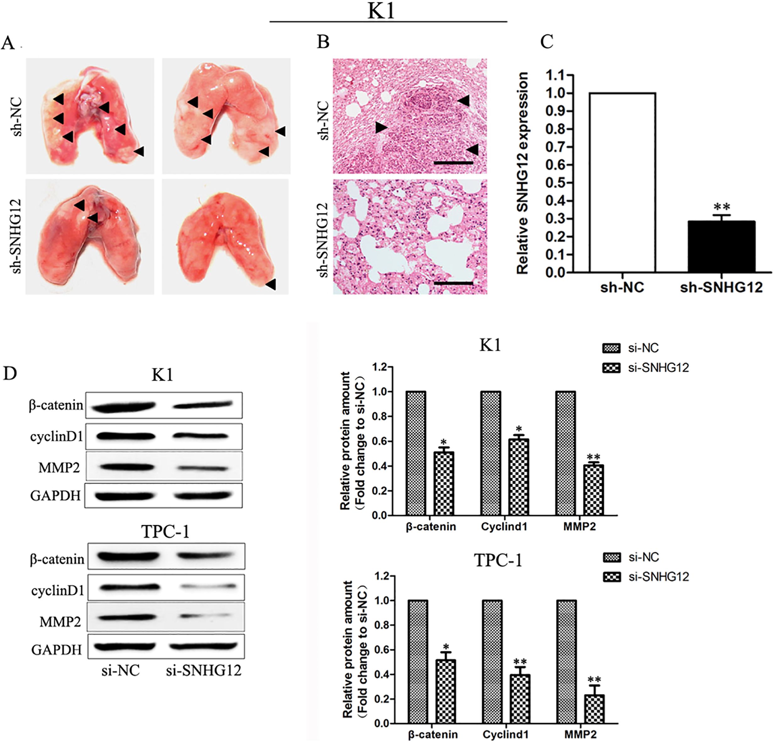 Lncrna Snhg Promotes The Proliferation And Metastasis Of Papillary