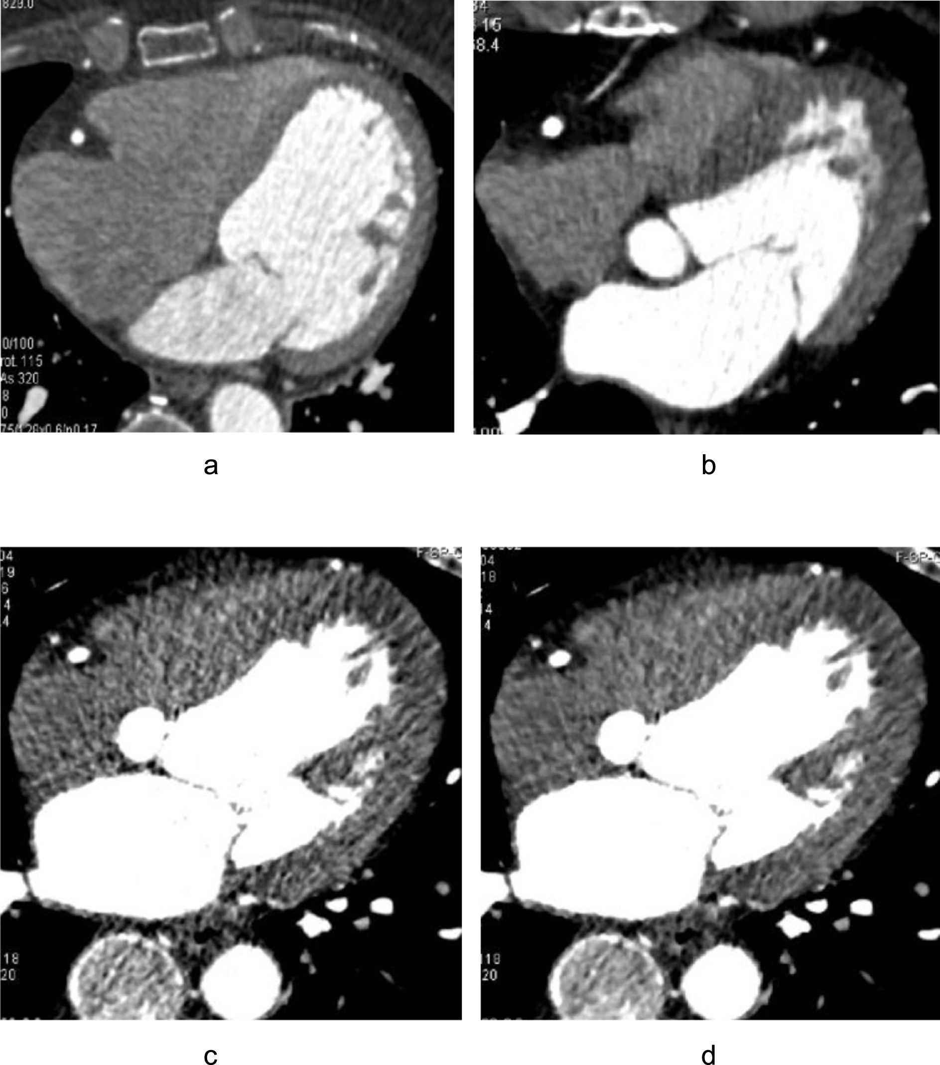 Submillisievert Coronary CT Angiography With Adaptive Prospective ECG