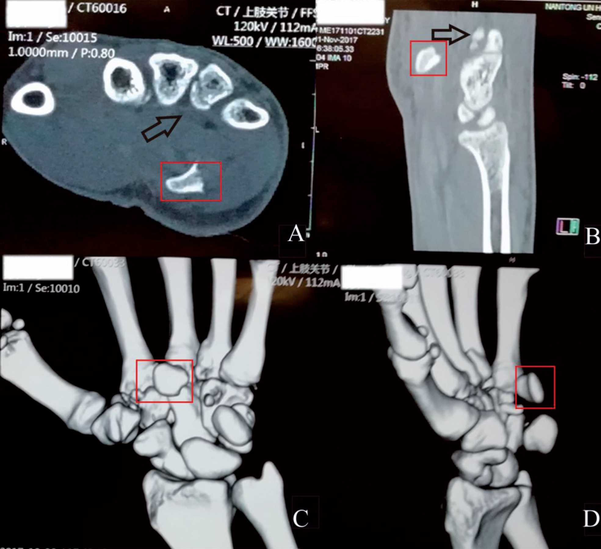 Diagnosis Of A Hamate Hook Fracture With D Reconstruction Of Computed