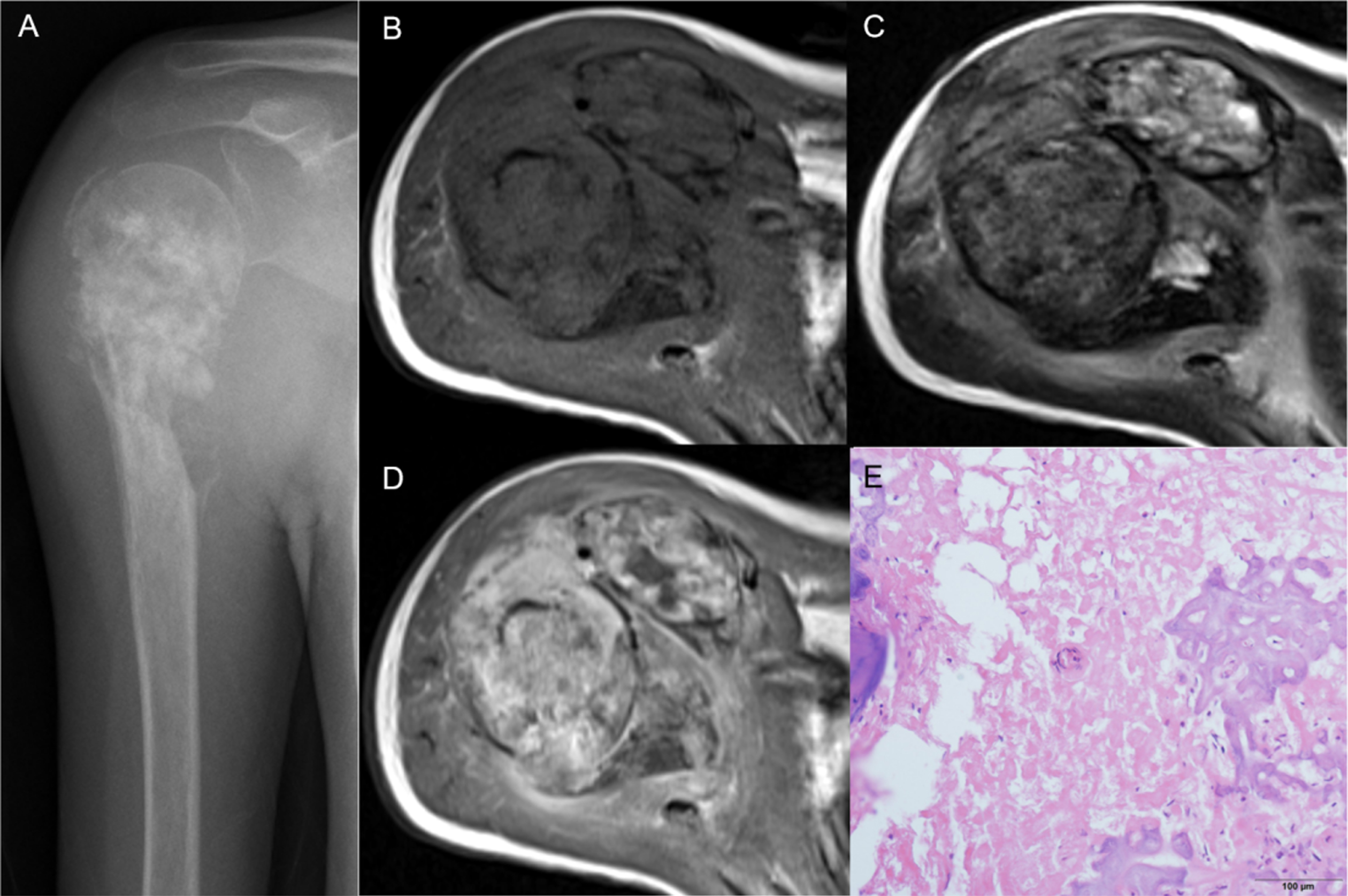 Prediction Of Response To Preoperative Neoadjuvant Chemotherapy In