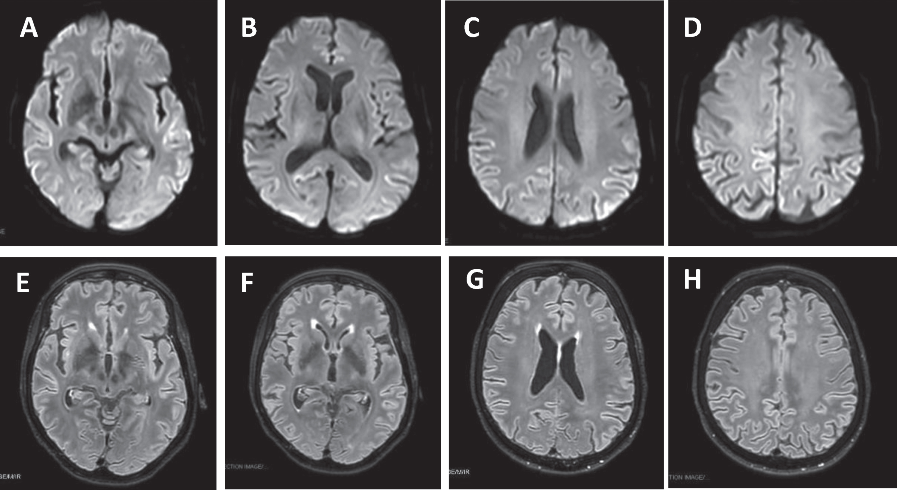 Creutzfeldt-Jakob Disease in a Patient with Previous COVID-19 Infection ...