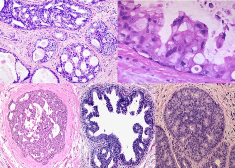 incidental-unilateral-and-bilateral-ductal-carcinoma-in-situ