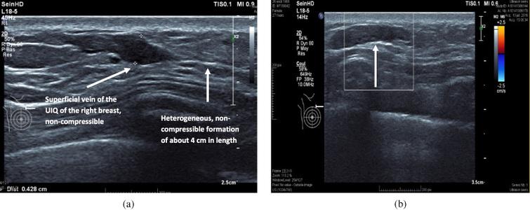 Recurrent Mondor S Breast Disease Hormonal Contraceptive Involvement Ios Press