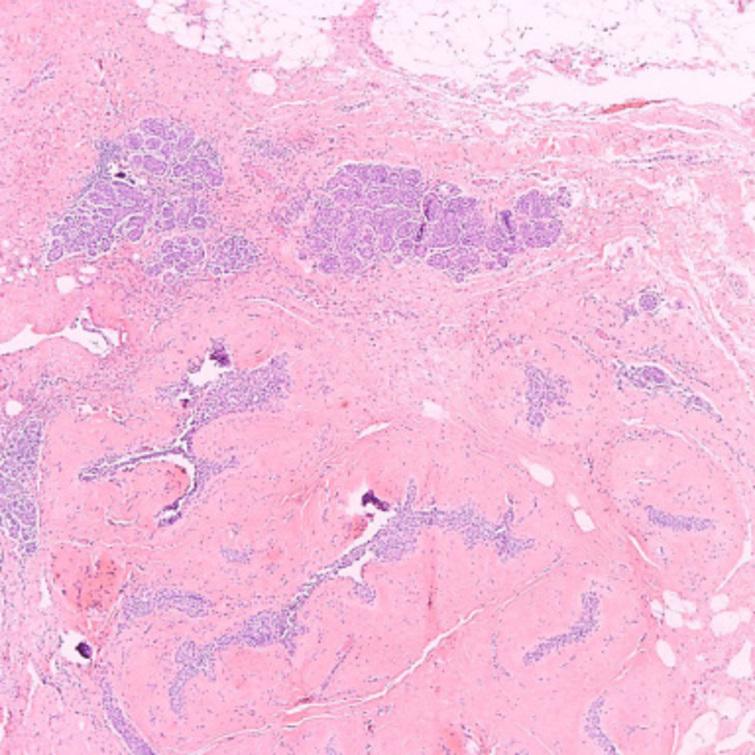 A clinicopathological study of fibroadenomas with epithelial ...