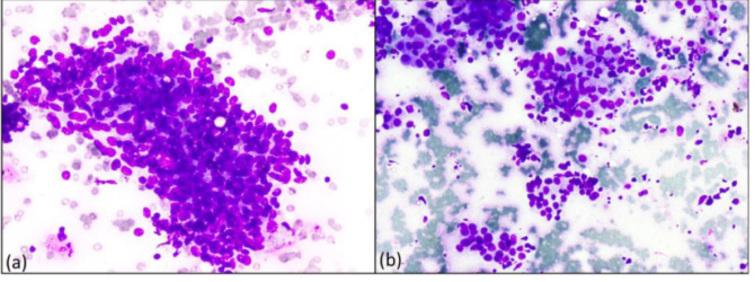 IAC standardized reporting of breast fine-needle aspiration cytology ...