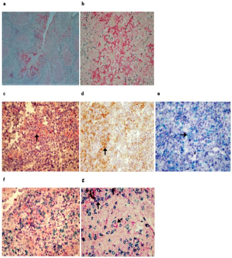 PD-L1 expression in tumor lesions and soluble PD-L1 serum levels in ...