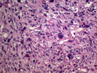 Primary stromal sarcoma of breast: A case report and literature review ...