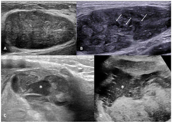 An integrative ultrasound-pathology approach to improve preoperative ...