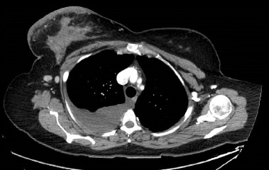 Breast metastasis presenting as swelling with calcification – A case ...