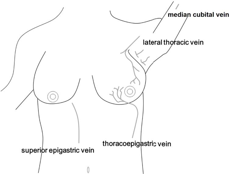 mondor s disease 1 images clipart