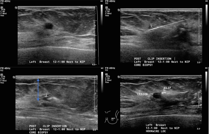 Sonographic visibility of the UltraCor TM Twirl TM tissue marker - IOS ...