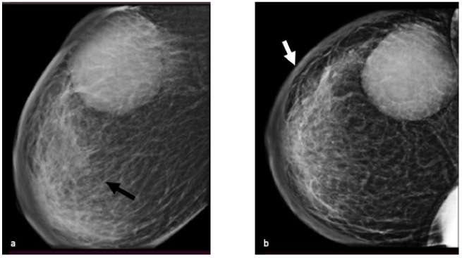 Acute inflammatory response to multiple chemotherapy regimen in breast ...