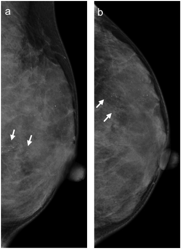 Clinicopathological and imaging features of ductal carcinoma in situ in ...