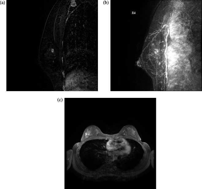 Pseudoangiomatous stromal hyperplasia of the breast, imaging and ...