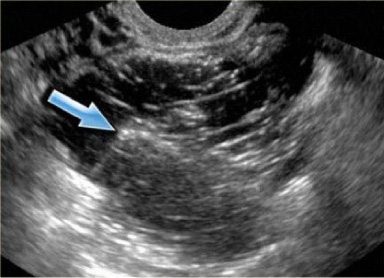 Borderline phyllodes tumor arising in ectopic breast tissue in the ...