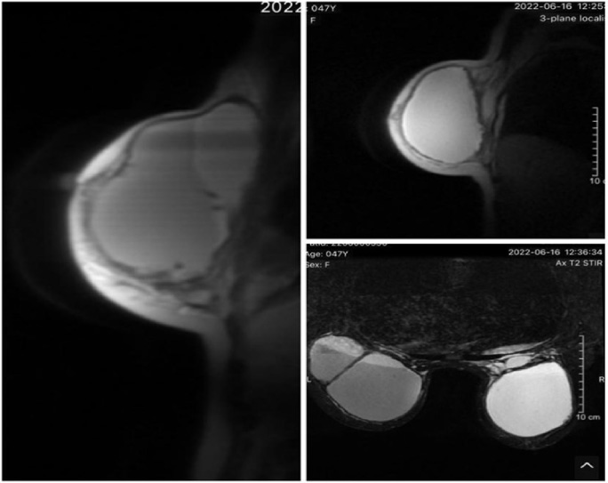 Complications of severe breast deformities after a silicone injection ...