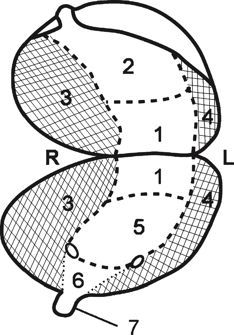 Pelvic Lymph Node Dissection May Be Limited On The Contralateral Side   Blc 2 Blc150031 G001 