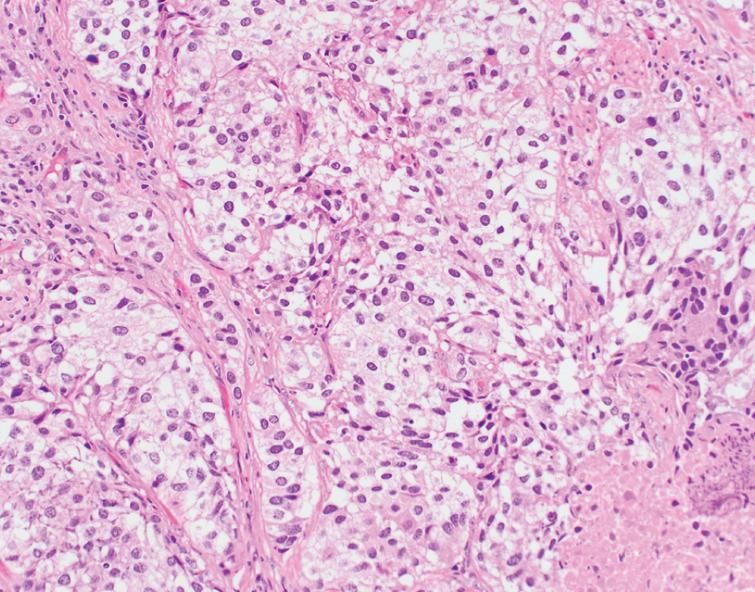 Histologic Variants of Urothelial Carcinoma: Morphology, Molecular ...