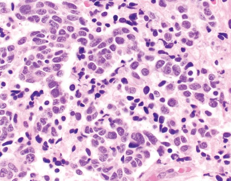 Histologic Variants of Urothelial Carcinoma: Morphology, Molecular ...