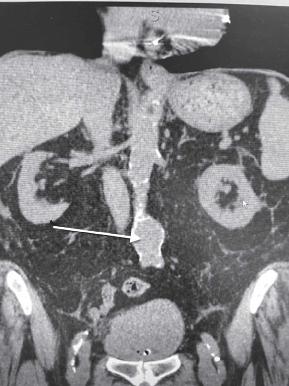 CT scan identifying the abdominal aorta aneurysm (arrow).