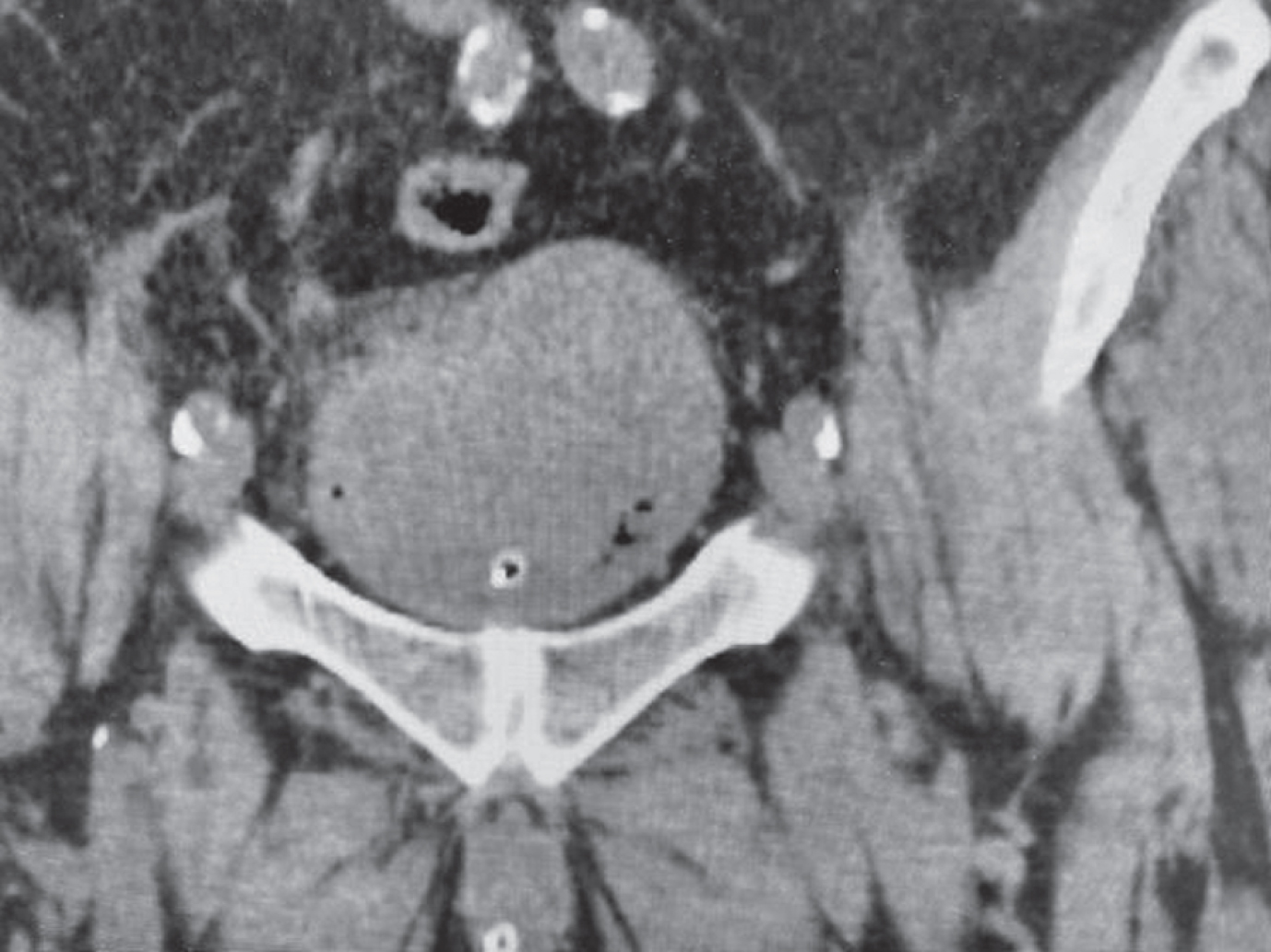 The non contrast CT scan identifies a large bladder mass.