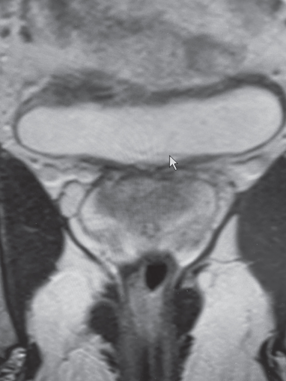 MRI indicating a small area of thickening of the bladder wall with an invasive bladder cancer being one of the alternatives.