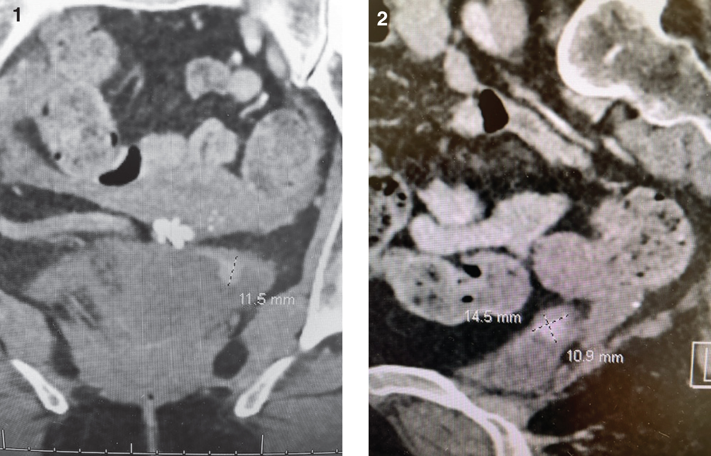 Coronal and sagital planes identifying the small bladder tumor.