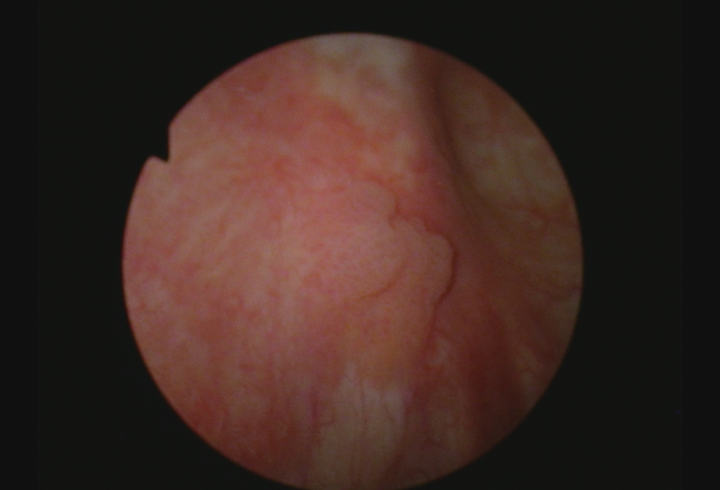 Small papillary tumor.