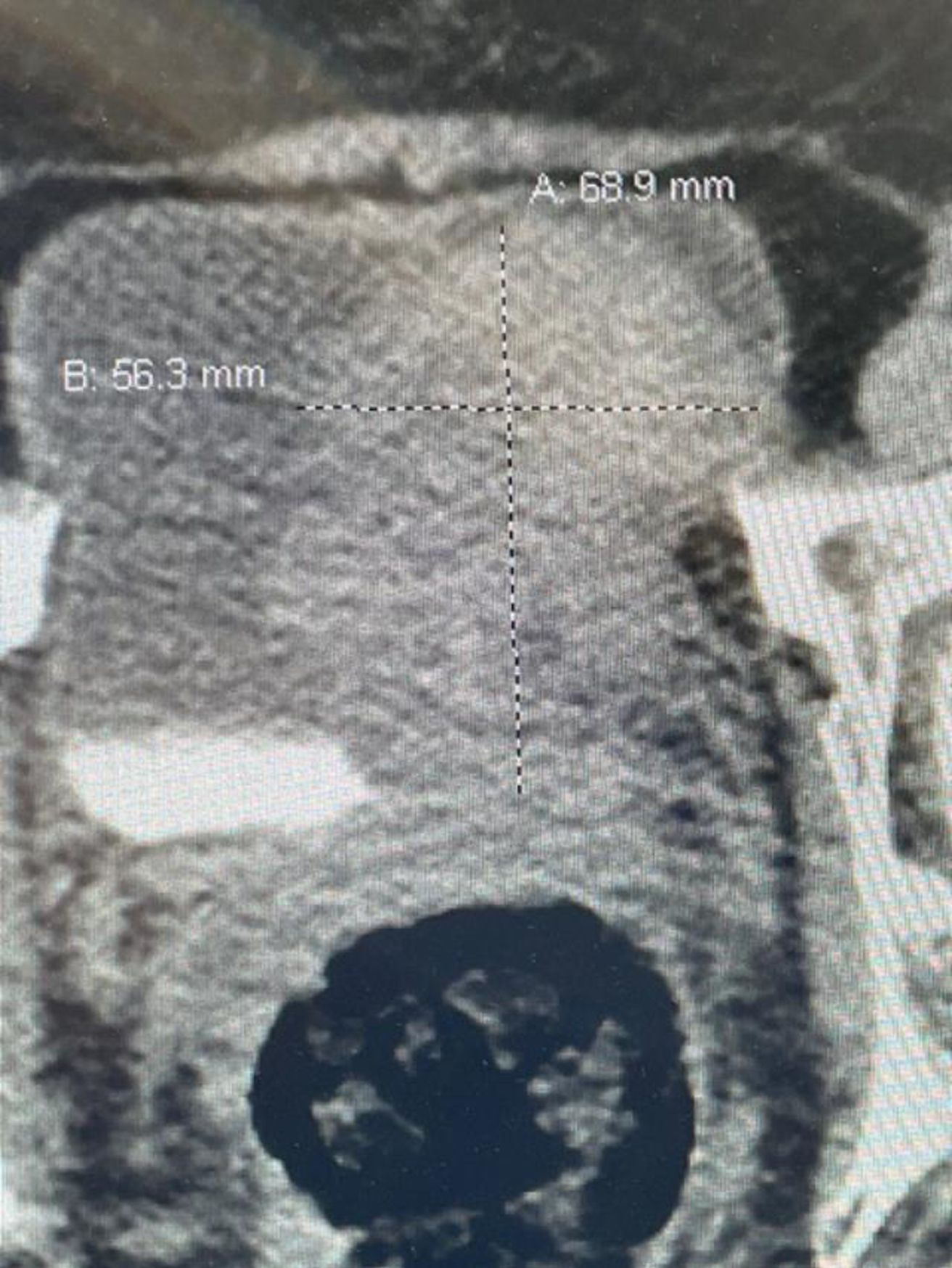CT scan image indicating the large bladder tumor left wall.