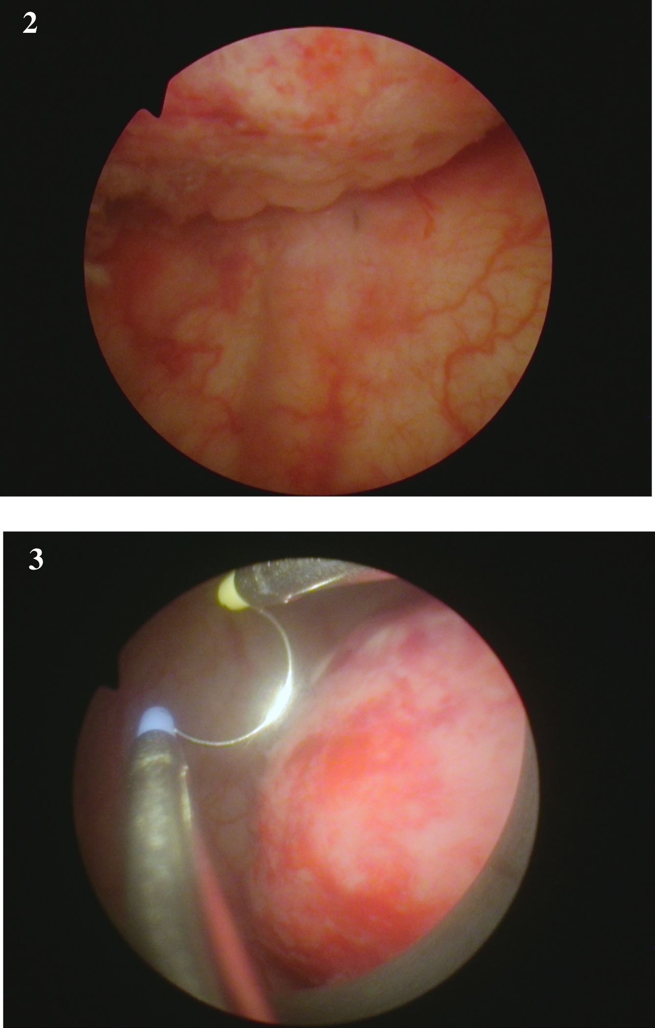 Endoscopic appearance of the large solid appearing tumor and the loop to provide an idea of the size.