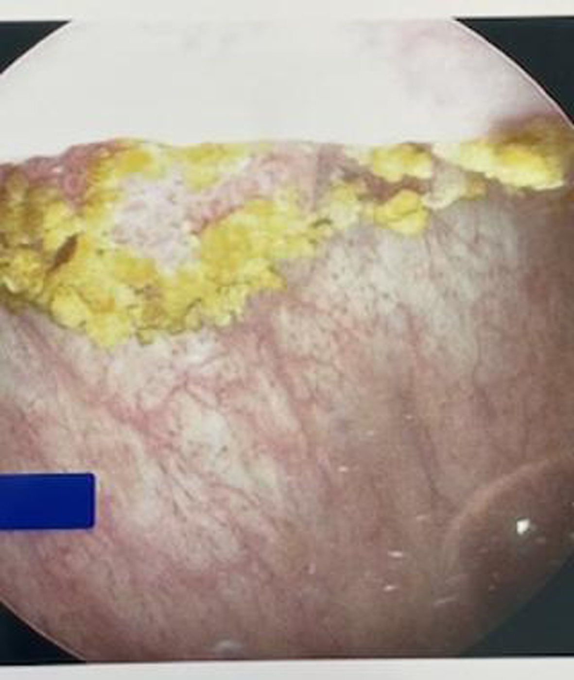 Flexible cystoscopy in office identifies a large anterior exophytic bladder tumor.