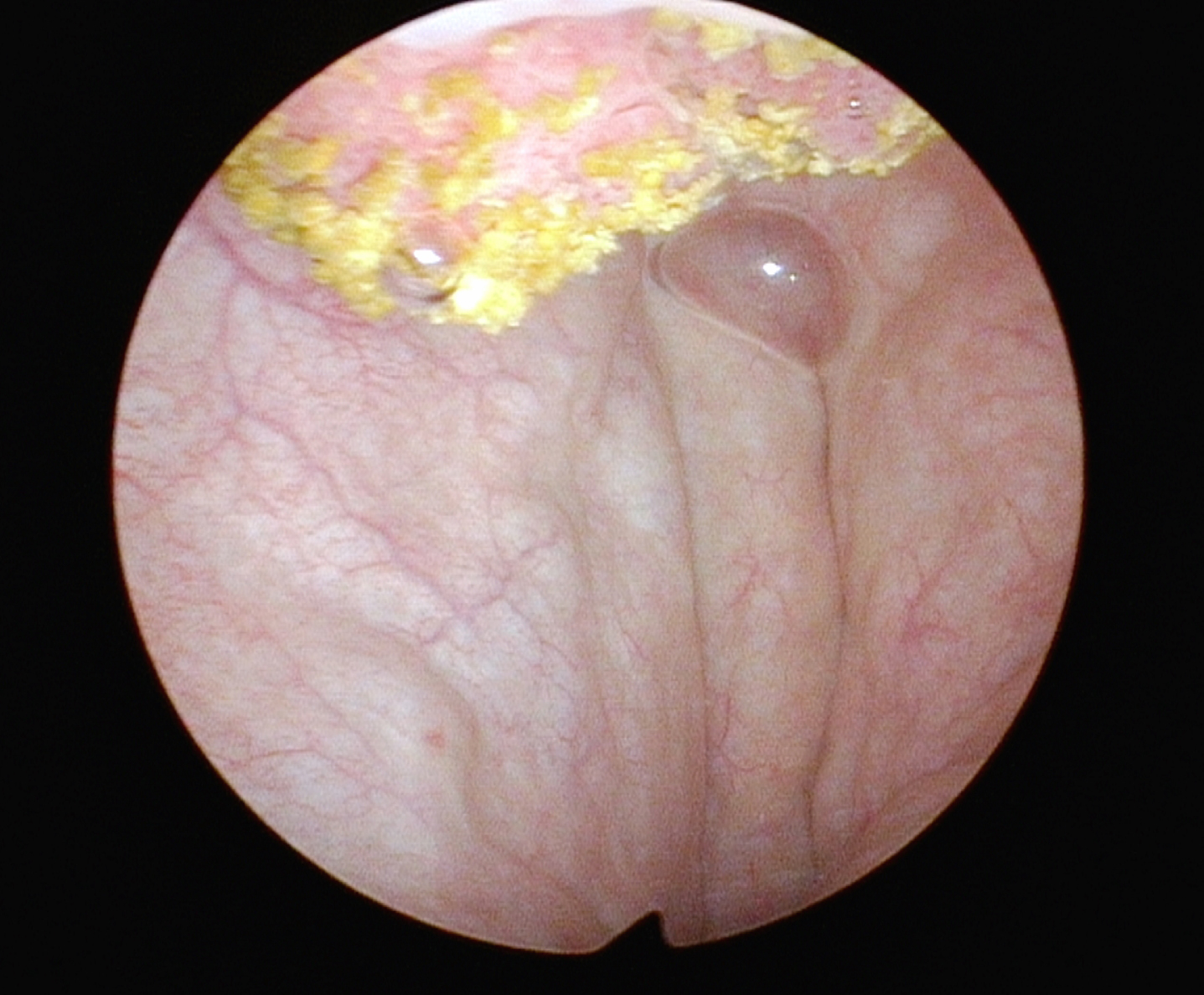 Cystoscopic appearance with 70 degree lens allows visualization of some of the tumor.