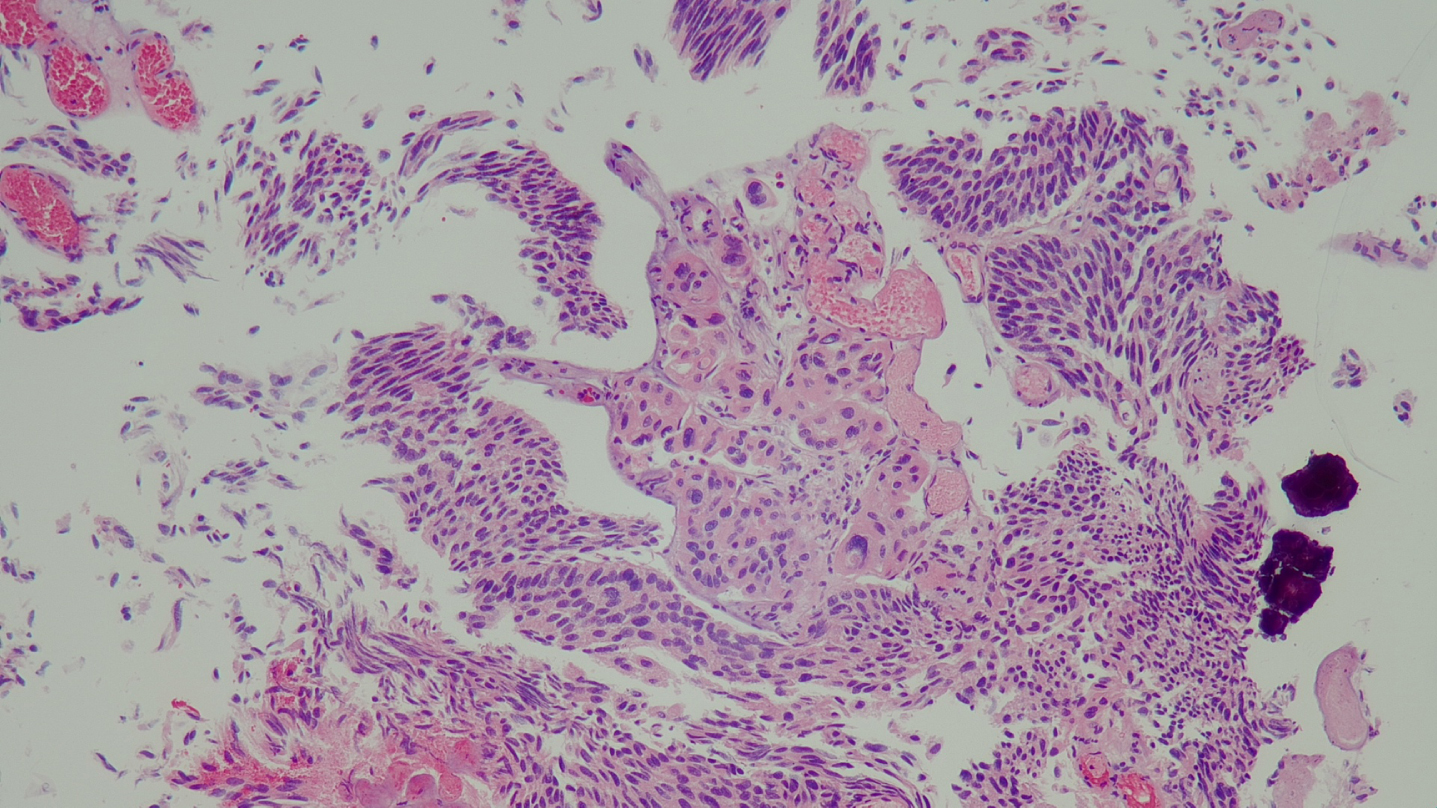 Histology of the high grade urothelial carcinoma with minimal invasion of the lamina propria.