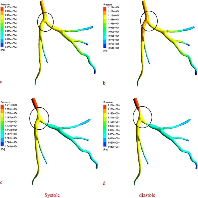 Patient specific 3-d modeling of blood flow in a multi-stenosed left ...