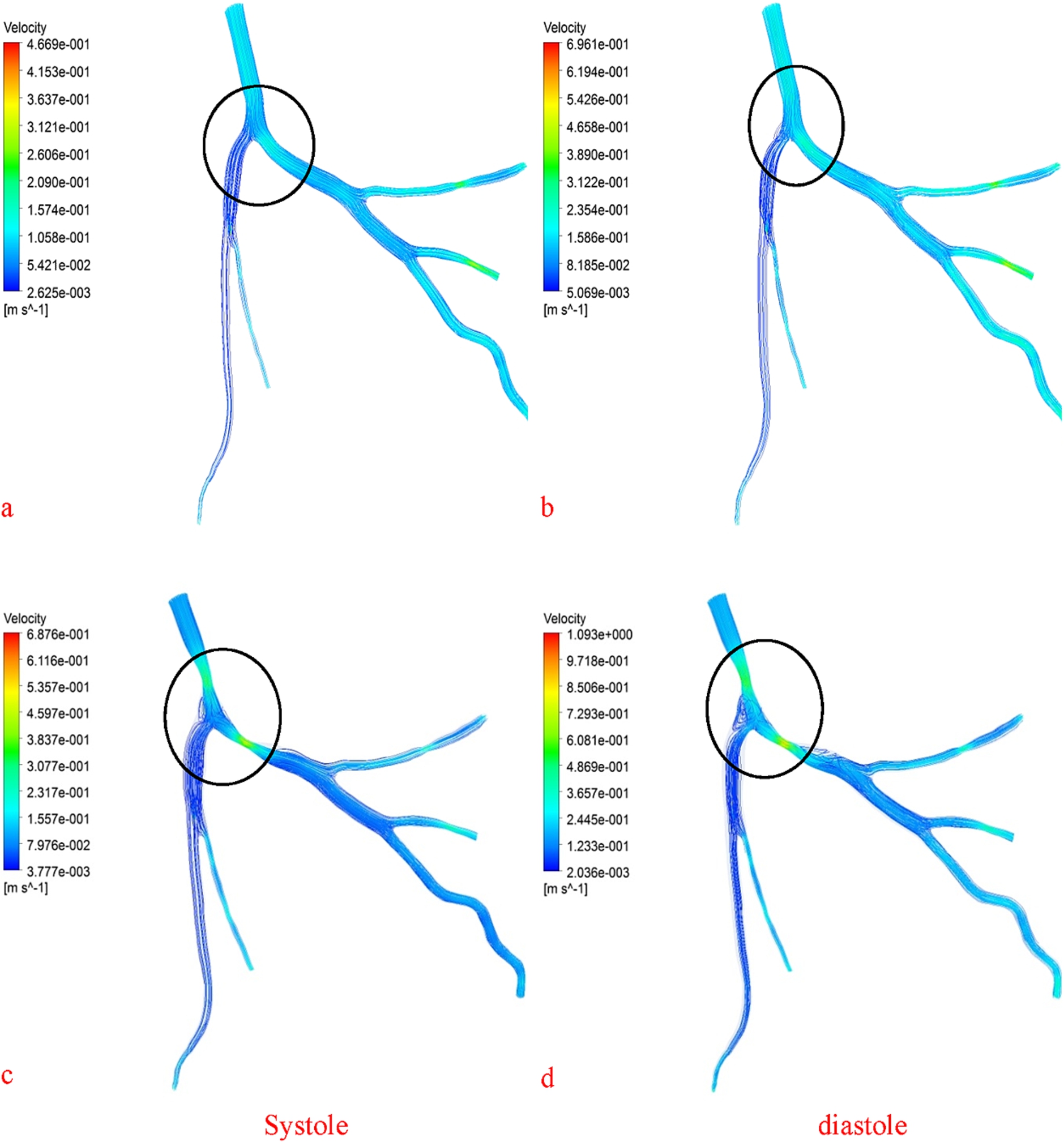 Patient specific 3-d modeling of blood flow in a multi-stenosed left ...