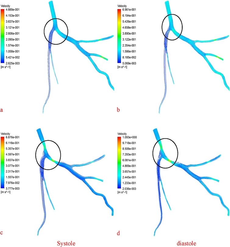 Patient specific 3-d modeling of blood flow in a multi-stenosed left ...