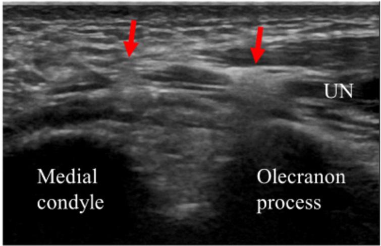 Availability of ultrasound screening for asymptomatic elbow injuries in ...