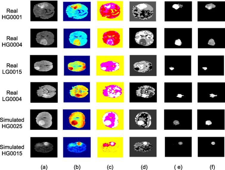 Automated Brain Tumor Segmentation From Multi Slices Flair Mri Images Ios Press