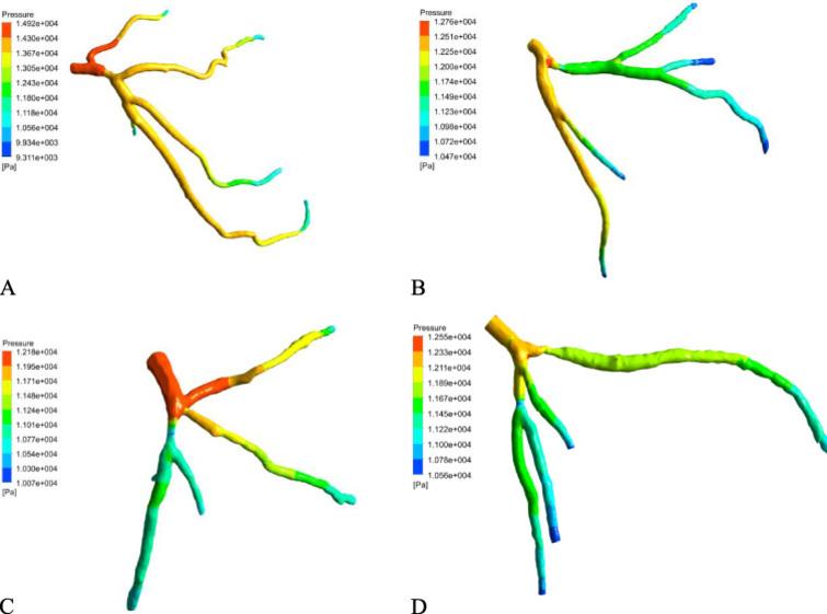 Effect of stenosis on hemodynamics in left coronary artery based on ...