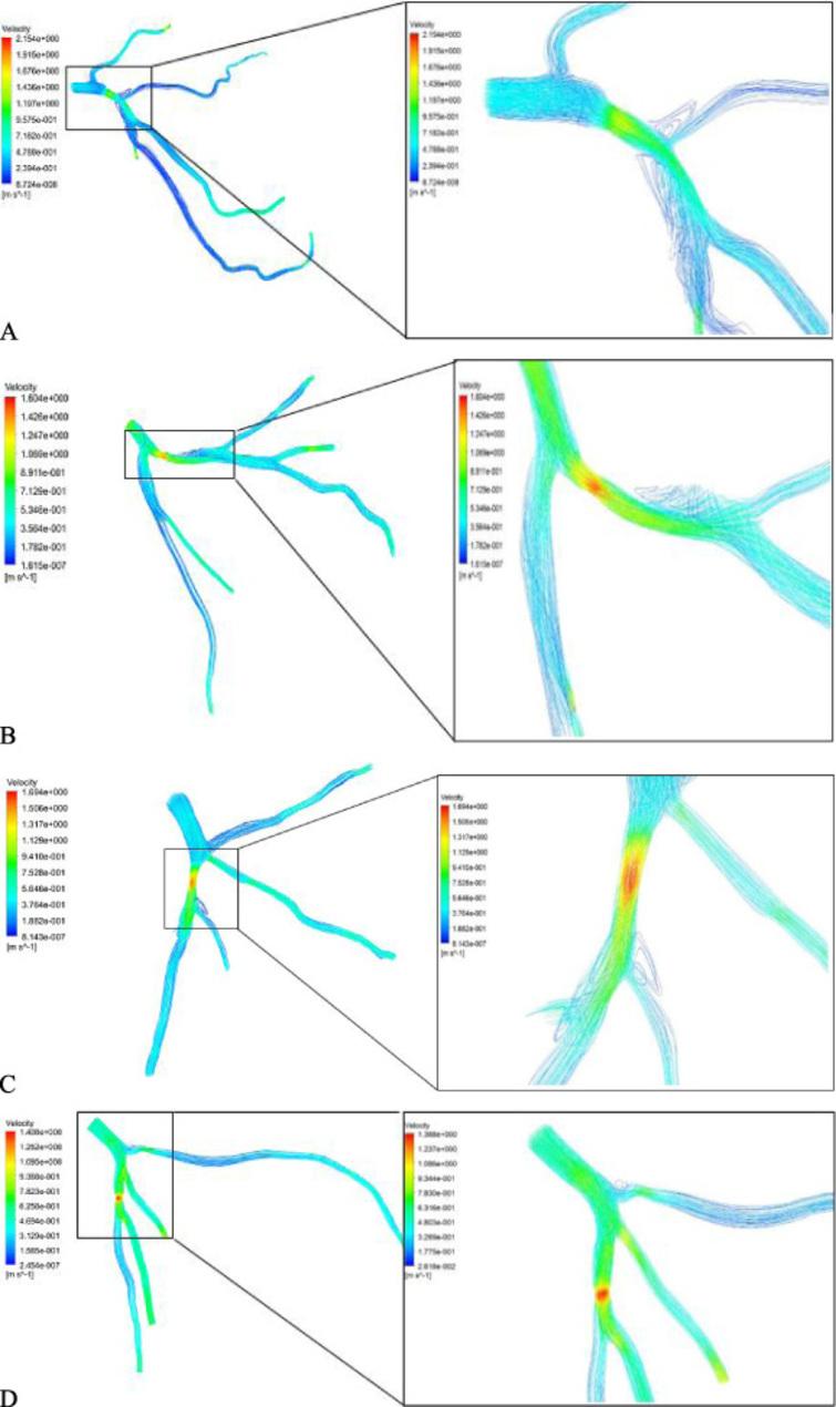 Effect Of Stenosis On Hemodynamics In Left Coronary Artery Based On 