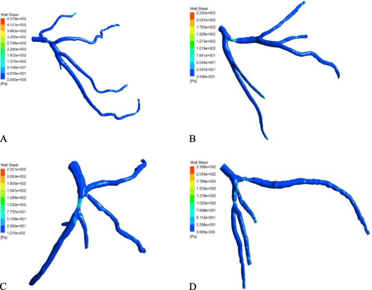 Effect of stenosis on hemodynamics in left coronary artery based on ...