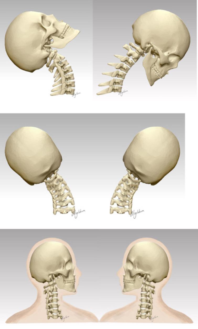 Cervical Spine Range Of Motion Chart