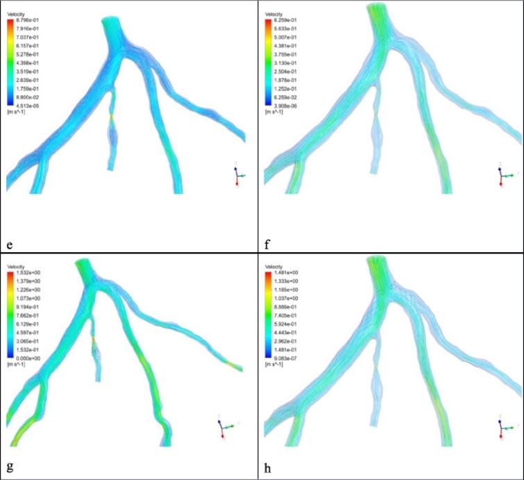 Investigation of two-way fluid-structure interaction of blood flow in a ...