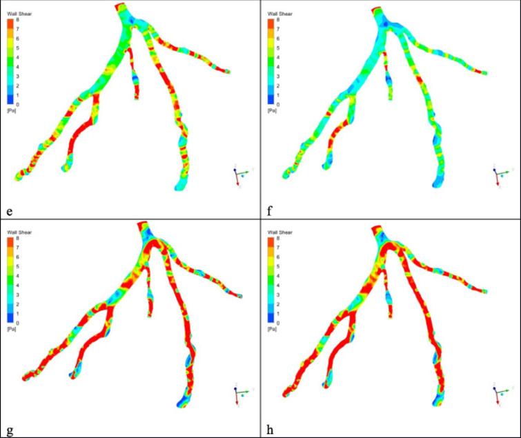 Investigation of two-way fluid-structure interaction of blood flow in a ...