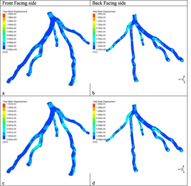 Investigation of two-way fluid-structure interaction of blood flow in a ...