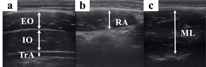 Association between trunk muscle mass and log of visual analog scale