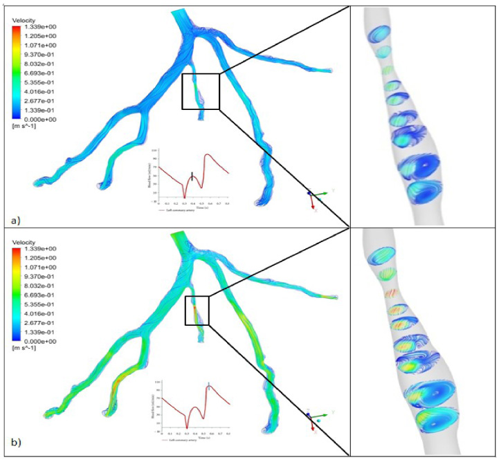 Visualization of multiphase pulsatile blood over single phase blood ...