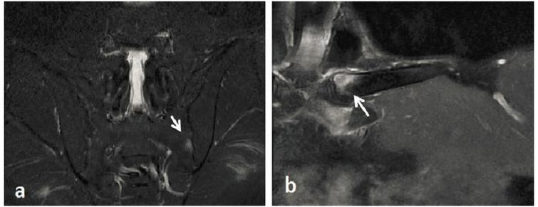 Pustulotic arthro-osteitis (Sonozaki Syndrome): A rare case report ...