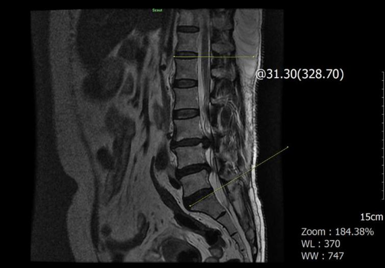 Normal aging of the lumbar spine in women - IOS Press