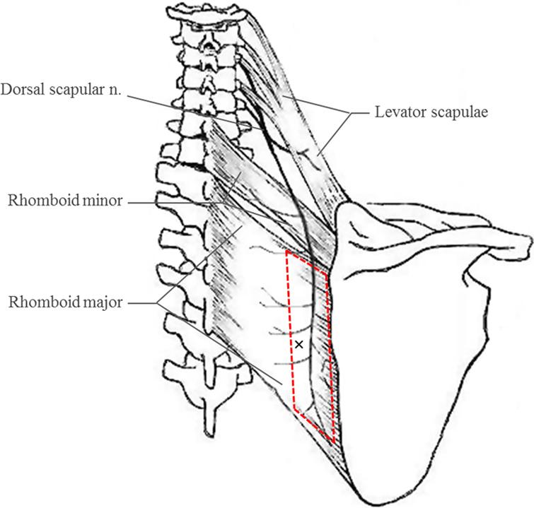 Dorsal Scapular Nerve Injury After Trigger Point Injection Into The Rhomboid Major Muscle A Case Report Ios Press